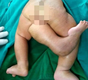INDE ; Le bébé né avec trois jambes
