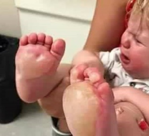 Une Nounou brûle sous les pieds d'un bébé avec une poêle chaude !